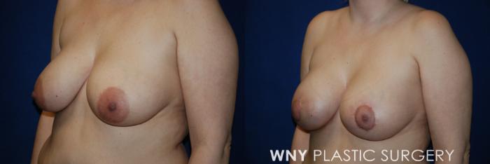 Before & After Breast Augmentation & Mini Lift Case 55 View #3 View in Buffalo, NY