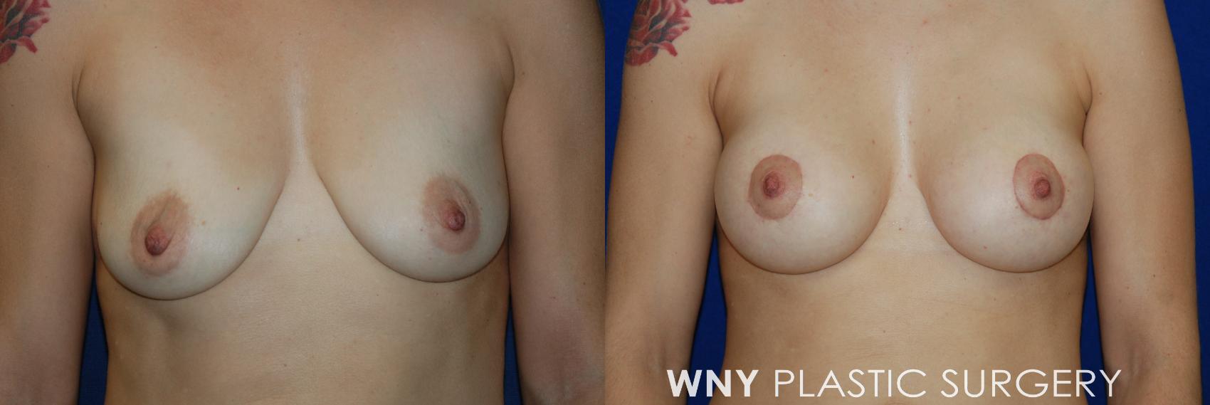 Before & After Breast Augmentation & Mini Lift Case 56 View #1 View in Buffalo, NY