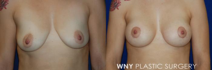Before & After Breast Augmentation & Mini Lift Case 56 View #1 View in Williamsville, NY
