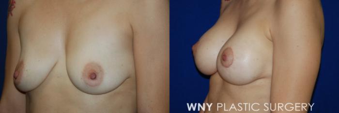 Before & After Breast Augmentation & Mini Lift Case 56 View #2 View in Buffalo, NY