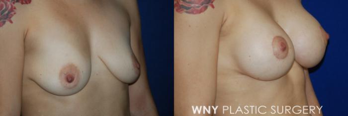 Before & After Breast Augmentation & Mini Lift Case 56 View #3 View in Buffalo, NY
