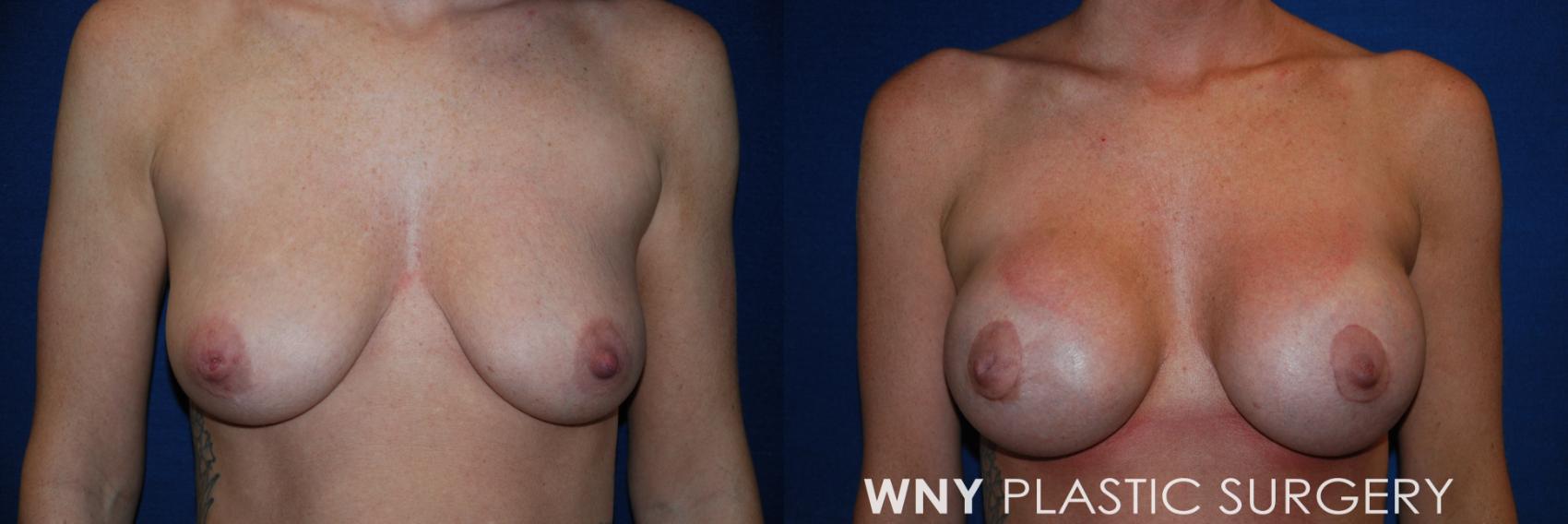 Before & After Breast Augmentation & Mini Lift Case 70 View #1 View in Buffalo, NY