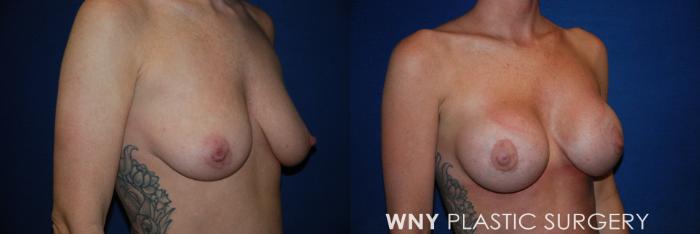 Before & After Breast Augmentation & Mini Lift Case 70 View #2 View in Buffalo, NY