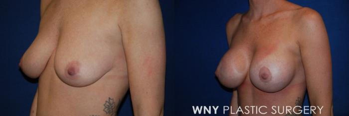 Before & After Breast Augmentation & Mini Lift Case 70 View #3 View in Buffalo, NY