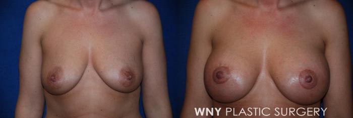 Before & After Breast Augmentation & Mini Lift Case 82 View #1 View in Williamsville, NY