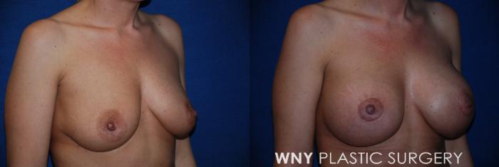 Before & After Breast Augmentation & Mini Lift Case 82 View #2 View in Williamsville, NY