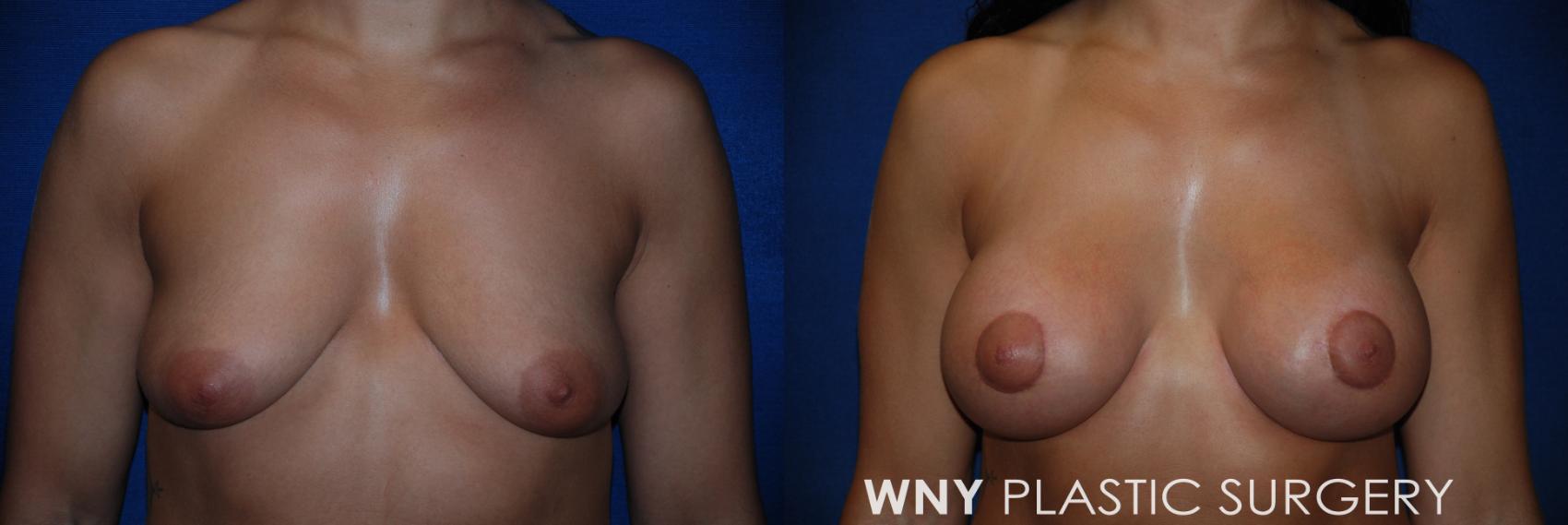 Before & After Breast Augmentation & Mini Lift Case 88 View #1 View in Buffalo, NY