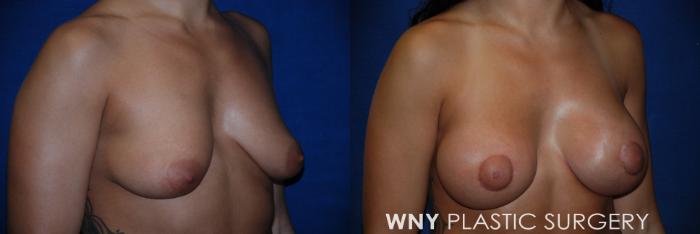 Before & After Breast Augmentation & Mini Lift Case 88 View #2 View in Buffalo, NY