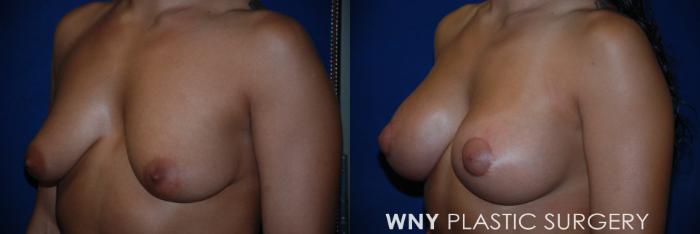 Before & After Breast Augmentation & Mini Lift Case 88 View #3 View in Buffalo, NY