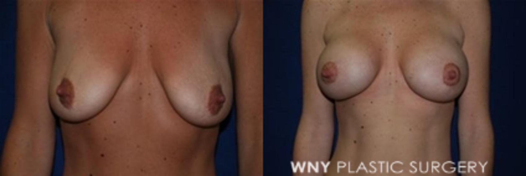 Before & After Breast Augmentation & Mini Lift Case 9 View #1 View in Buffalo, NY