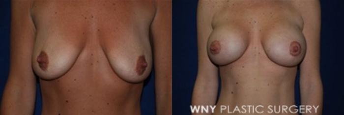 Before & After Breast Augmentation & Mini Lift Case 9 View #1 View in Williamsville, NY