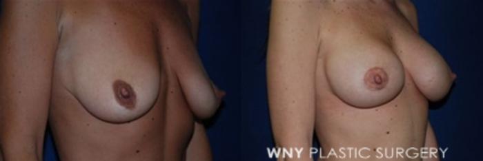 Before & After Breast Augmentation & Mini Lift Case 9 View #2 View in Buffalo, NY