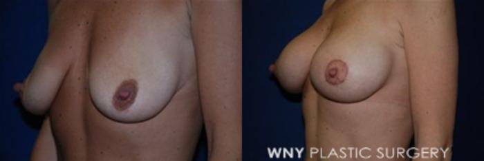 Before & After Breast Augmentation & Mini Lift Case 9 View #3 View in Buffalo, NY