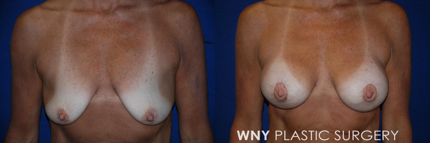 Before & After Breast Augmentation & Mini Lift Case 91 View #1 View in Williamsville, NY