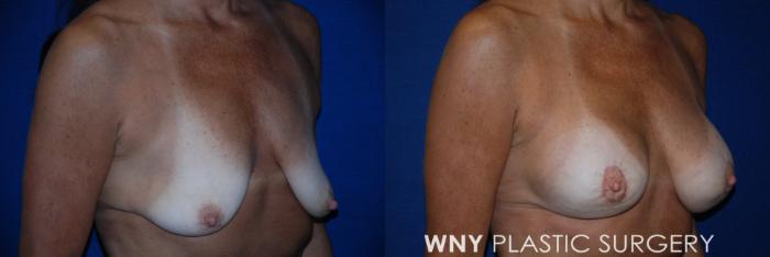 Before & After Breast Augmentation & Mini Lift Case 91 View #2 View in Williamsville, NY
