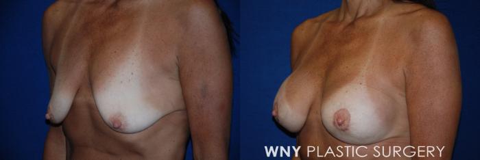 Before & After Breast Augmentation & Mini Lift Case 91 View #3 View in Williamsville, NY