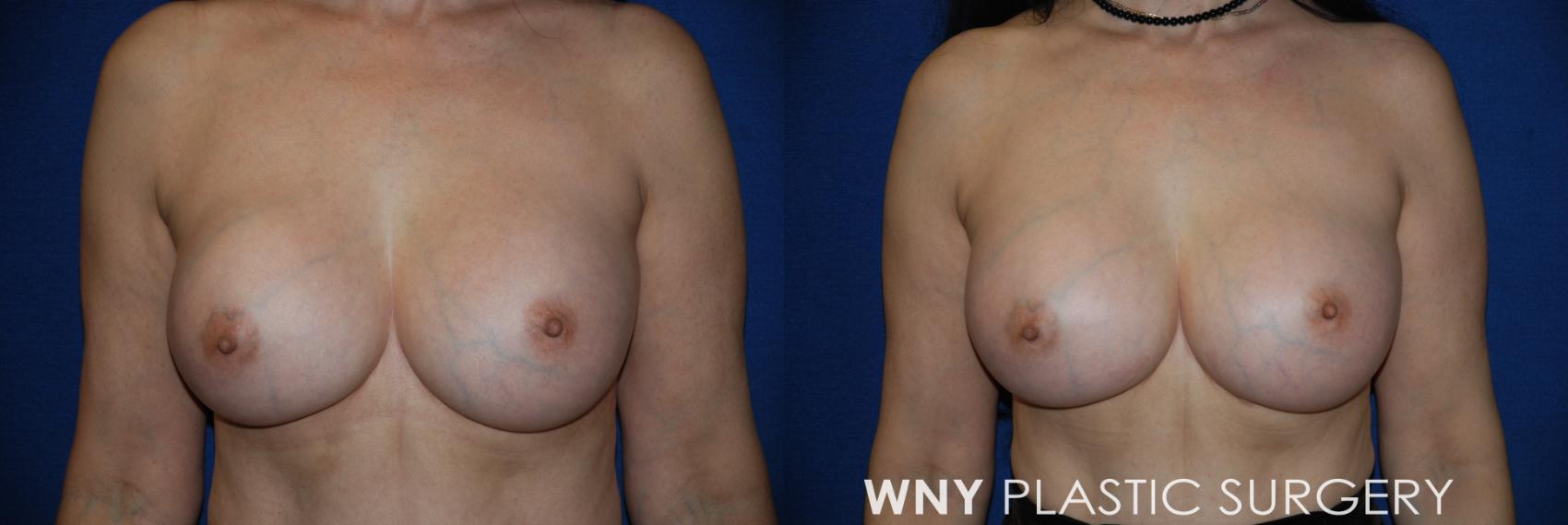 Before & After Breast Implant Replacement Case 159 View #1 View in Buffalo, NY