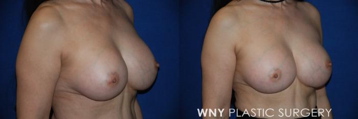 Before & After Breast Implant Replacement Case 159 View #2 View in Williamsville, NY
