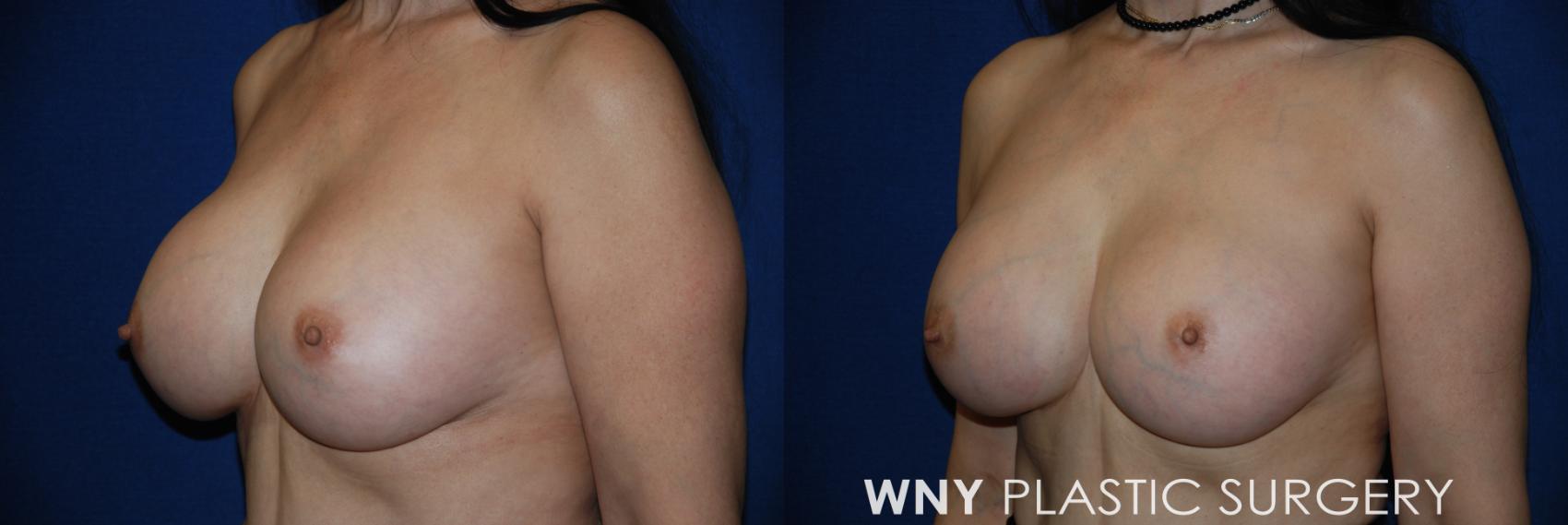 Before & After Breast Implant Replacement Case 159 View #3 View in Williamsville, NY
