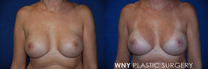 Before & After Breast Implant Replacement Case 161 View #1 View in Williamsville, NY
