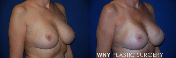 Before & After Breast Implant Replacement Case 161 View #2 View in Williamsville, NY