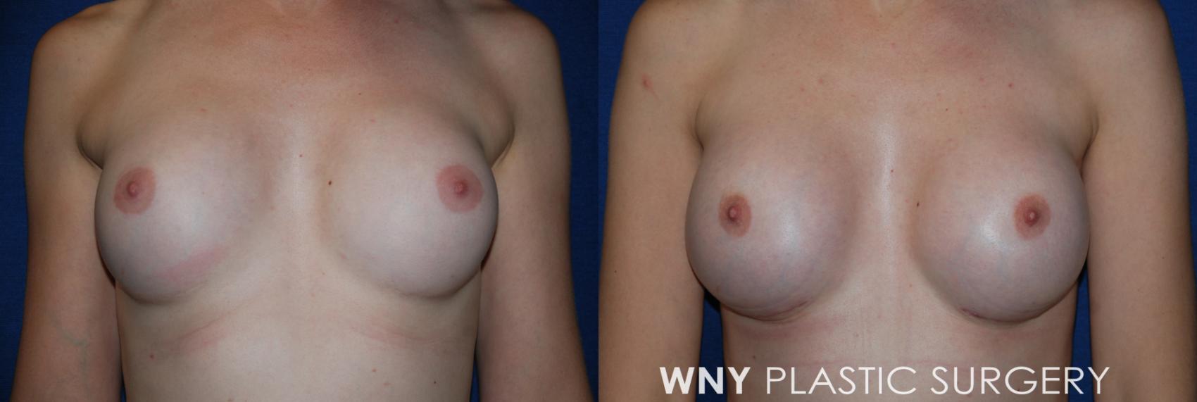 Before & After Breast Implant Replacement Case 216 Front View in Williamsville, NY