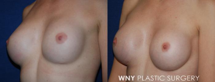 Before & After Breast Implant Replacement Case 216 Left Oblique View in Williamsville, NY