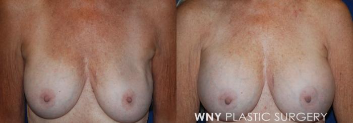 Before & After Breast Implant Replacement Case 218 Front View in Buffalo, NY