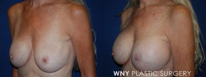 Before & After Breast Implant Replacement Case 218 Left Oblique View in Buffalo, NY