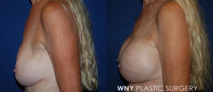 Before & After Breast Implant Replacement Case 218 Left Side View in Buffalo, NY