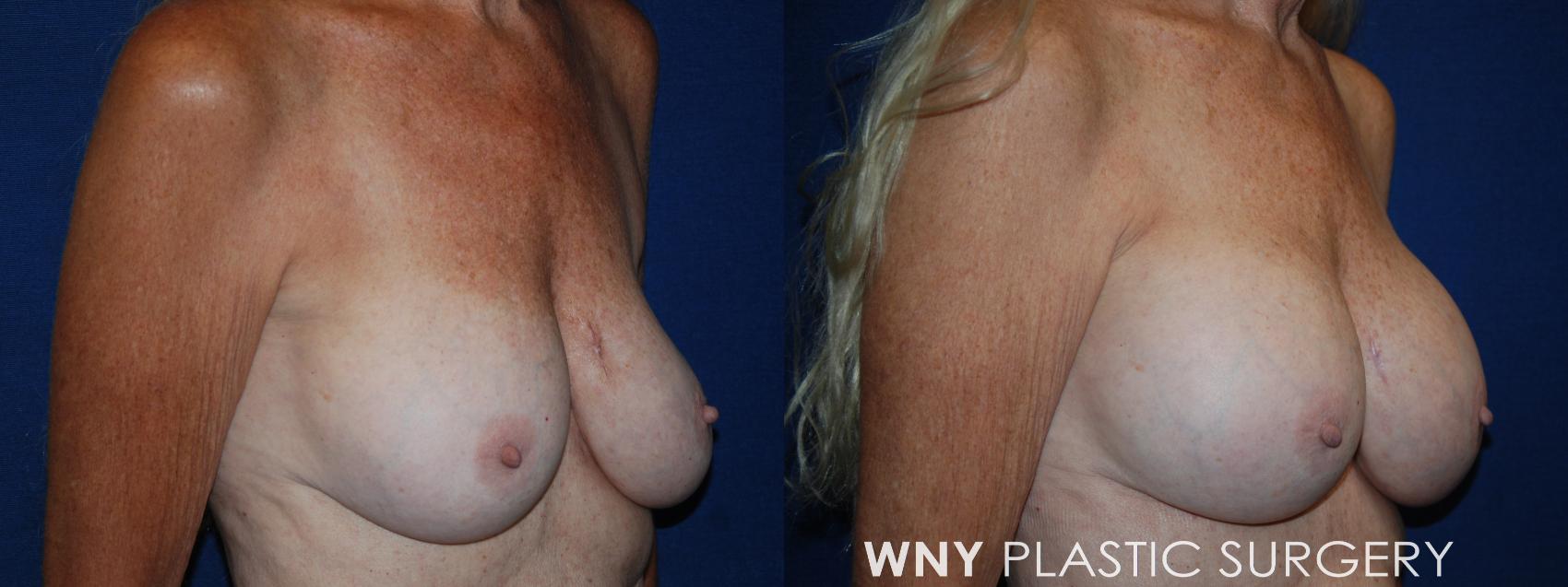 Before & After Breast Implant Replacement Case 218 Right Oblique View in Williamsville, NY