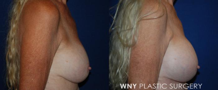 Before & After Breast Implant Replacement Case 218 Right Side View in Buffalo, NY