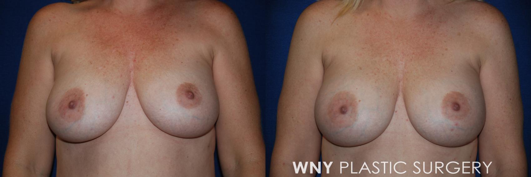 Before & After Breast Implant Replacement Case 221 Front View in Buffalo, NY