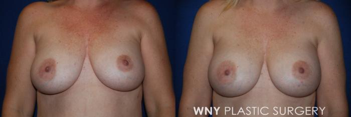 Before & After Breast Implant Replacement Case 221 Front View in Williamsville, NY