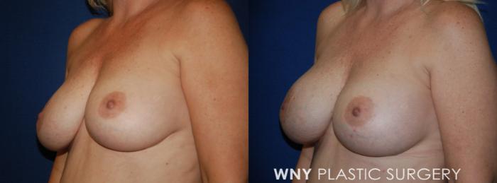 Before & After Breast Implant Replacement Case 221 Left Oblique View in Buffalo, NY