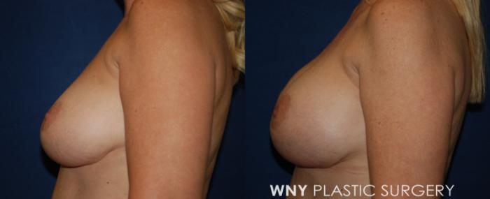 Before & After Breast Implant Replacement Case 221 Left Side View in Buffalo, NY