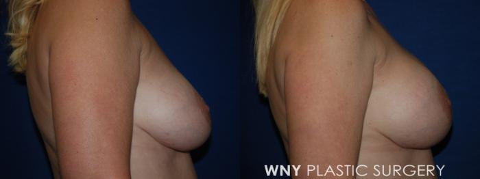 Before & After Breast Implant Replacement Case 221 Right Side View in Buffalo, NY