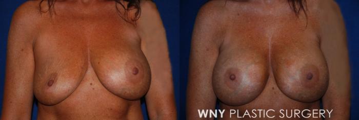 Before & After Breast Implant Replacement Case 223 Front View in Williamsville, NY