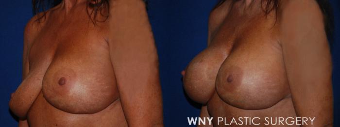 Before & After Breast Implant Replacement Case 223 Left Oblique View in Buffalo, NY