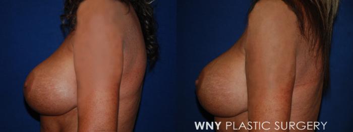 Before & After Breast Implant Replacement Case 223 Left Side View in Buffalo, NY