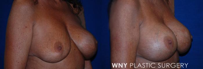 Before & After Breast Implant Replacement Case 223 Right Oblique View in Buffalo, NY
