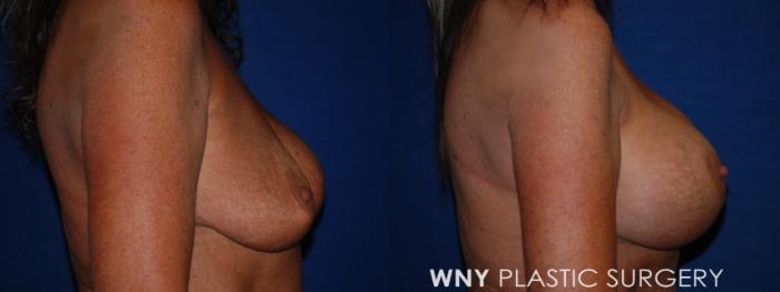 Before & After Breast Implant Replacement Case 223 Right Side View in Buffalo, NY