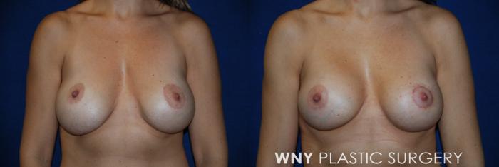 Before & After Breast Implant Replacement Case 43 View #1 View in Williamsville, NY