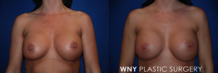 Before & After Breast Implant Replacement Case 62 View #1 View in Williamsville, NY