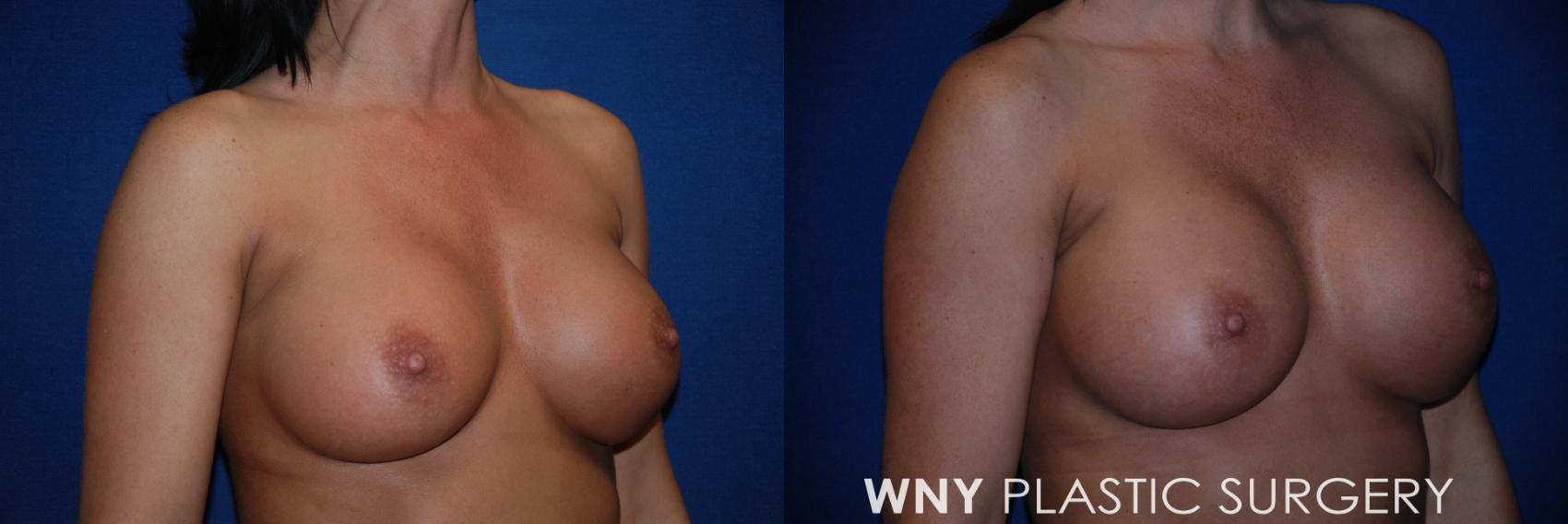 Before & After Breast Implant Replacement Case 62 View #2 View in Williamsville, NY