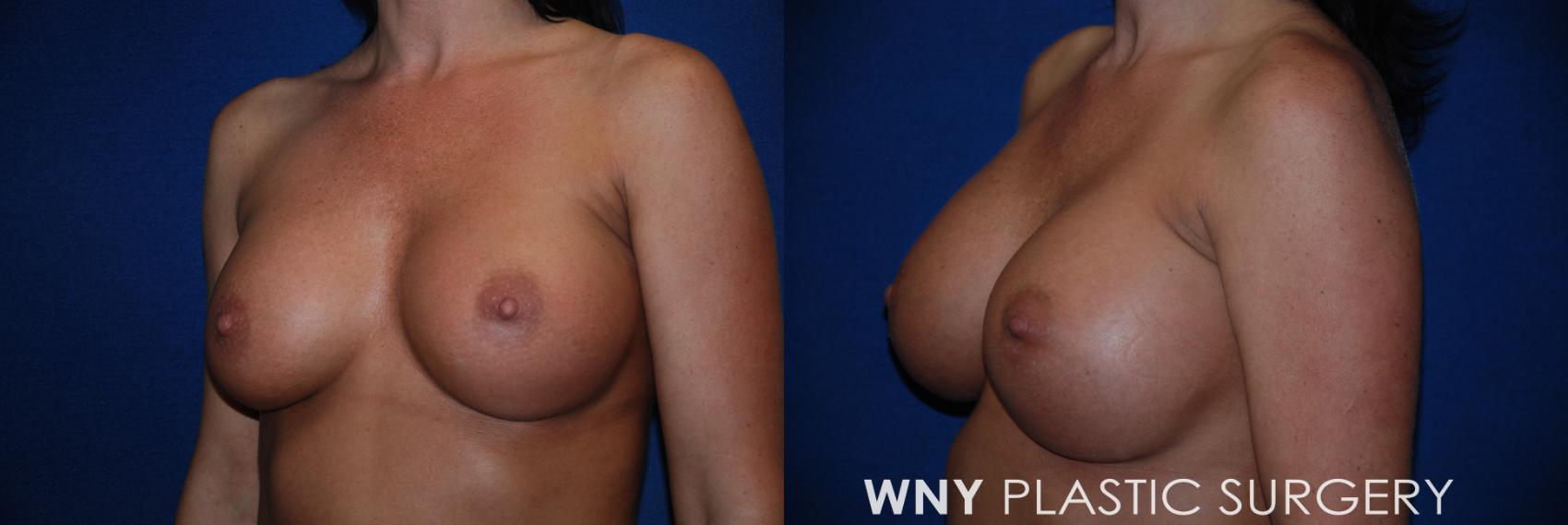 Before & After Breast Implant Replacement Case 62 View #3 View in Williamsville, NY