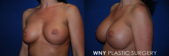Before & After Breast Implant Replacement Case 62 View #3 View in Williamsville, NY