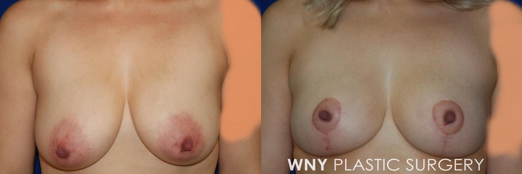 Before & After Breast Lift Case 106 View #1 View in Williamsville, NY