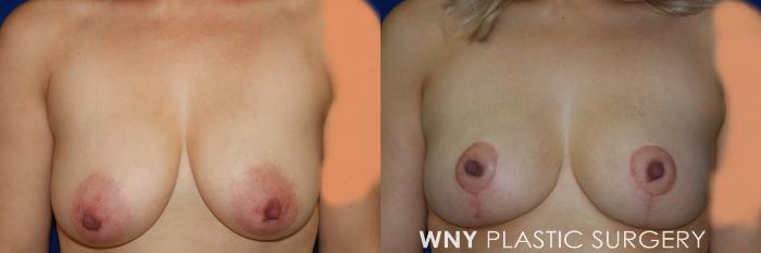 Before & After Breast Lift Case 106 View #1 View in Williamsville, NY