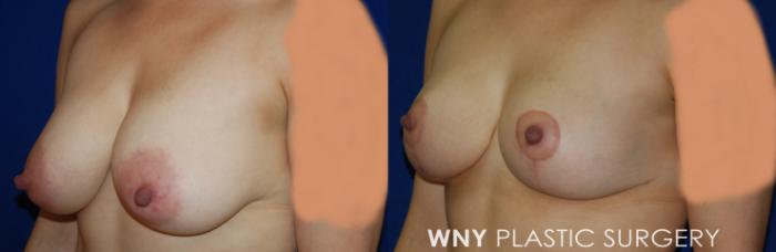 Before & After Breast Lift Case 106 View #3 View in Williamsville, NY